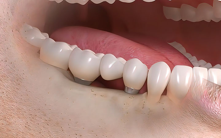 Vsadki iz titana Vsadki iz titana